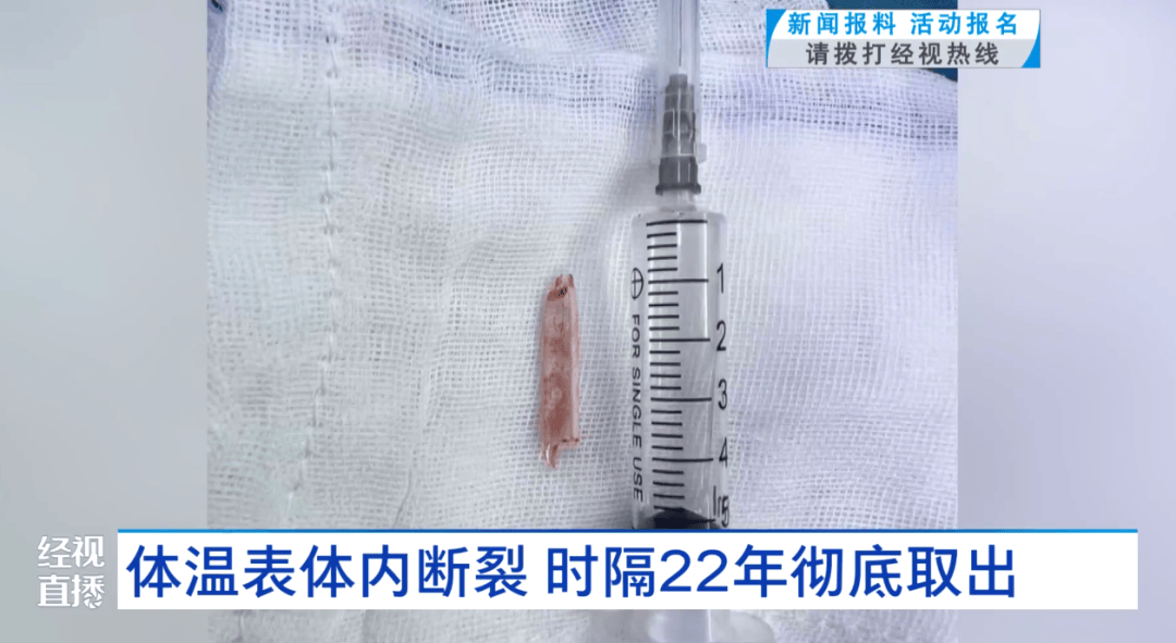 体温表在体内断裂,女子时隔22年彻底取出!医生:庆幸水银不在里面